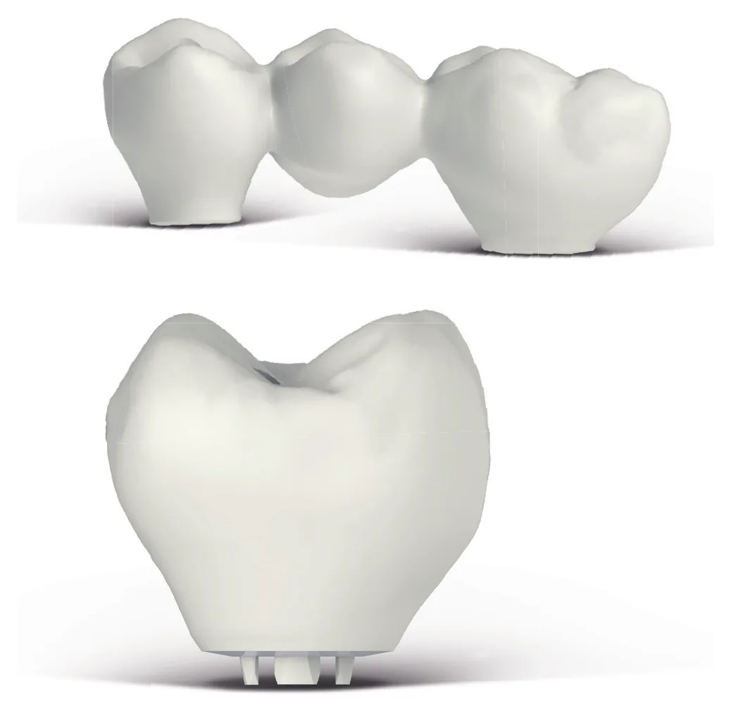 White monolithic zirconia bridge and crown