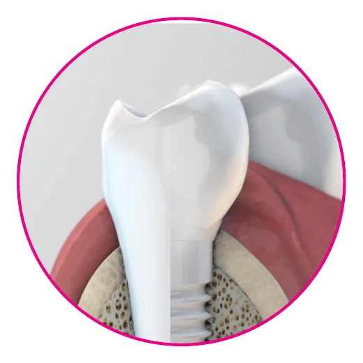 Close-up of a white zirconia implant and crown emerging through the gum