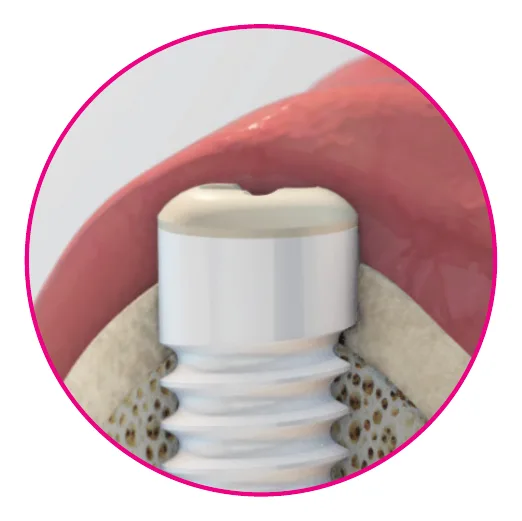 Close-up of healthy gingiva closely adapted around a zirconia implant
