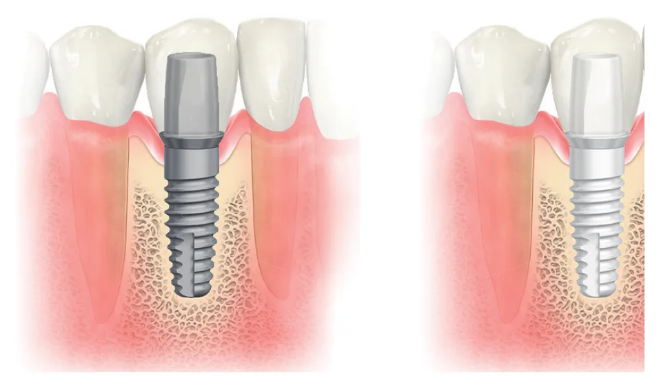 Illustration of a grey titanium implant and a white zirconia implant beneath the gum