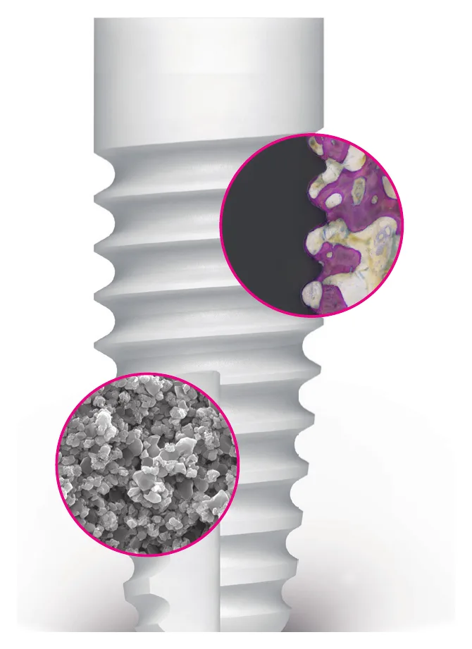 Zeramex XT implant with magnified views of the Zerafil surface and bone contact